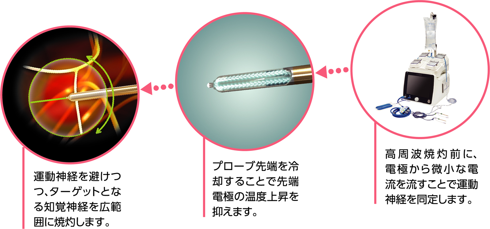 Coolief（クーリーフ）治療とは