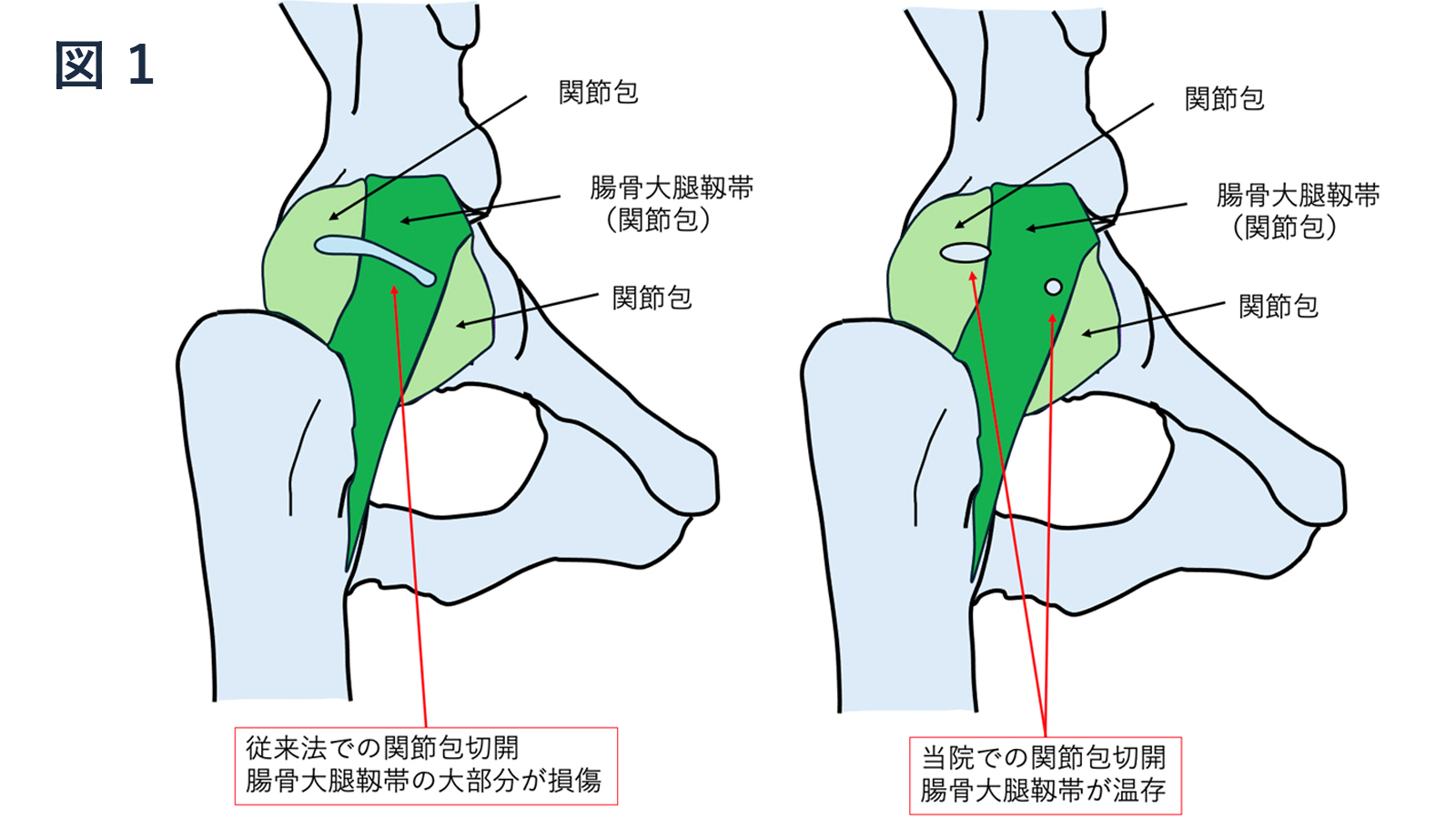 股関節鏡手術