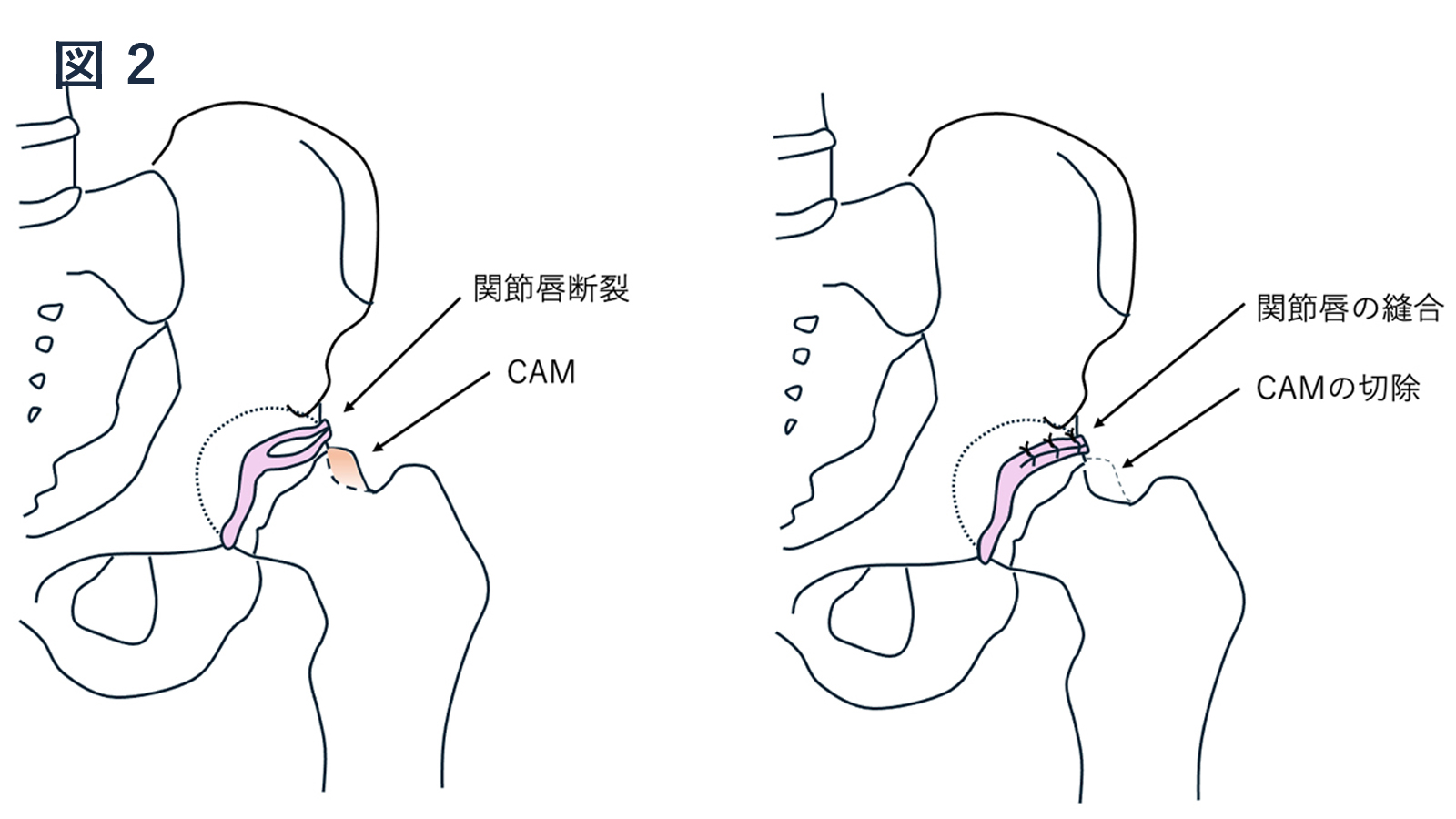 股関節鏡手術