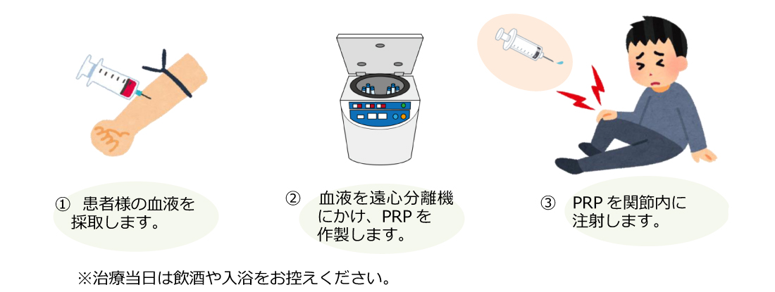 PRP治療の説明