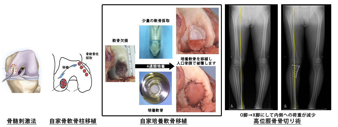 軟骨損傷（離断性骨軟骨炎、変形性膝関節症）
