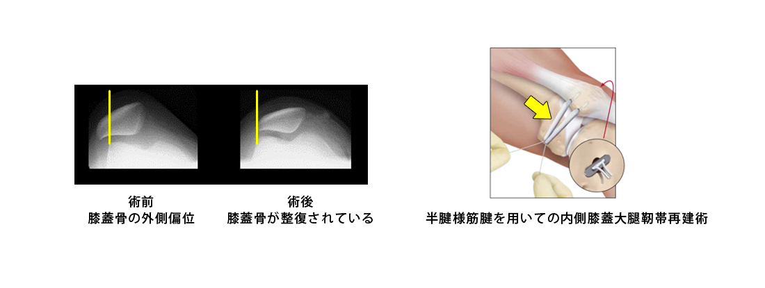 反復性膝蓋骨脱臼