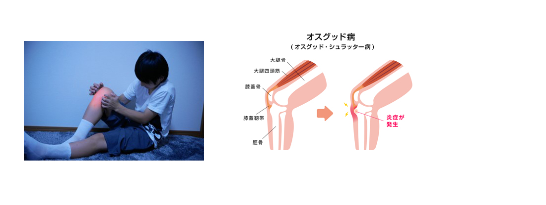 オスグッド病