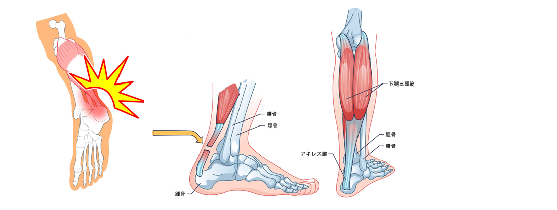 アキレス腱断裂