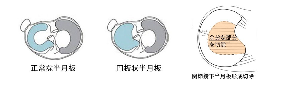 外側円板状半月板