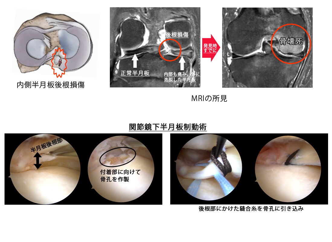 膝内側半月板後根損傷