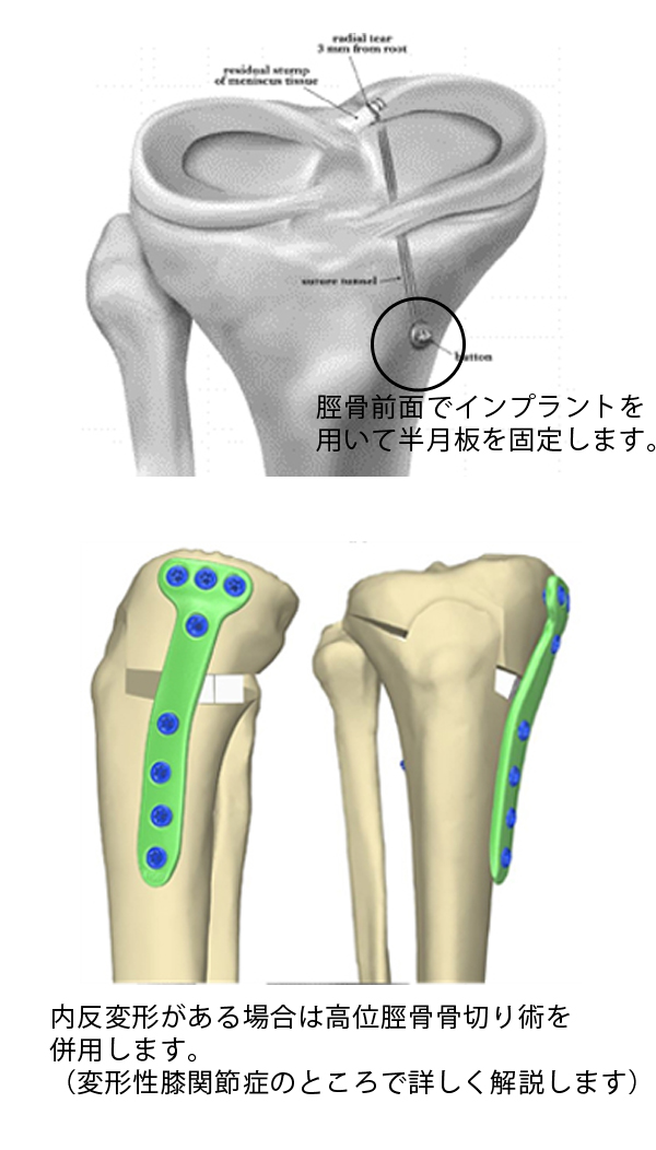 膝内側半月板後根損傷