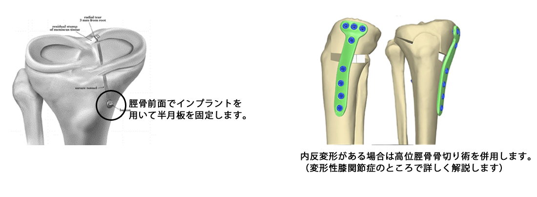 膝内側半月板後根損傷