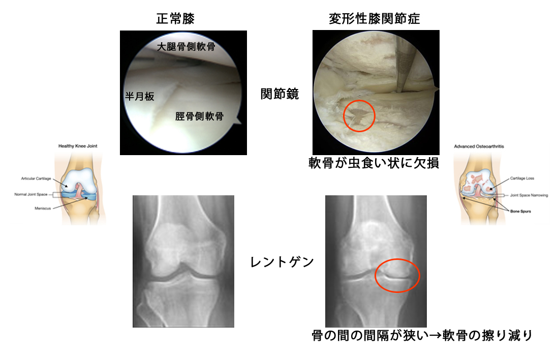 変形性膝関節症