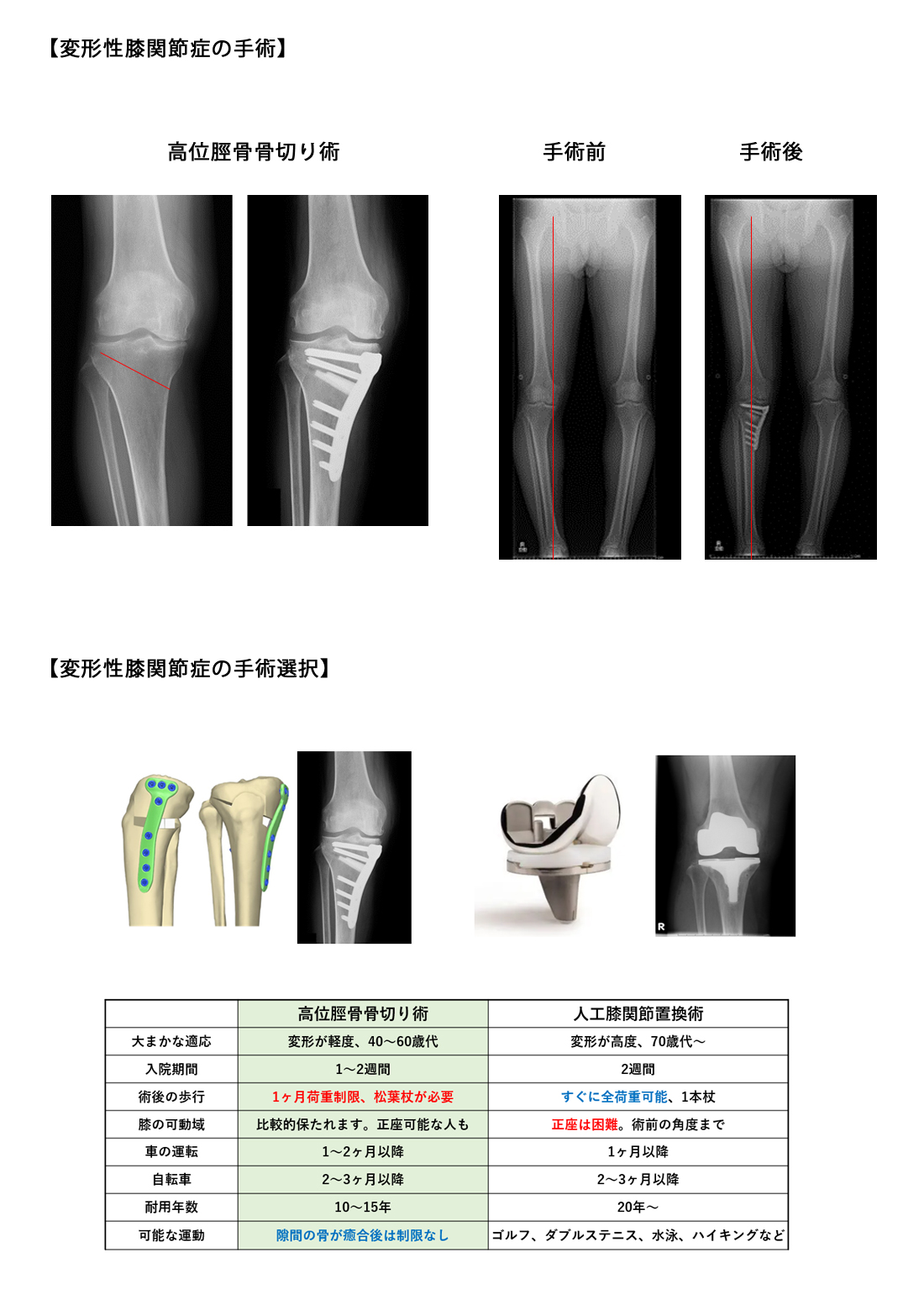 変形性膝関節症