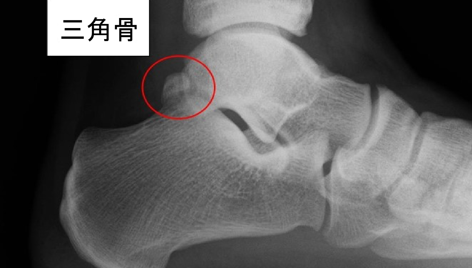 三角骨障害 / 足関節後方インピンジメント