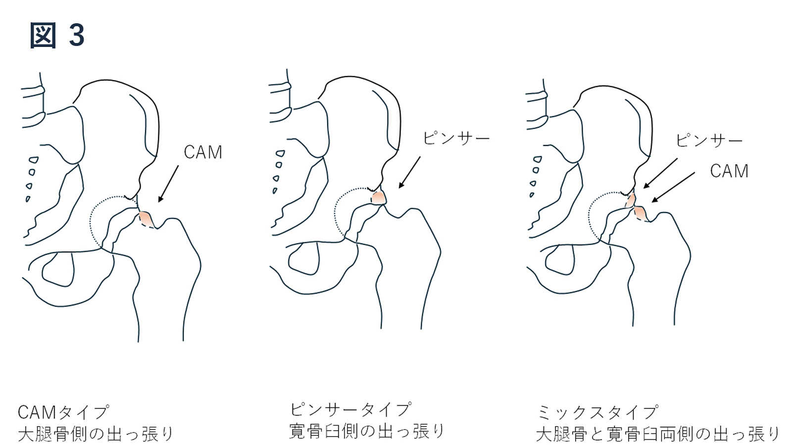 大腿骨寛骨臼インピンジメント