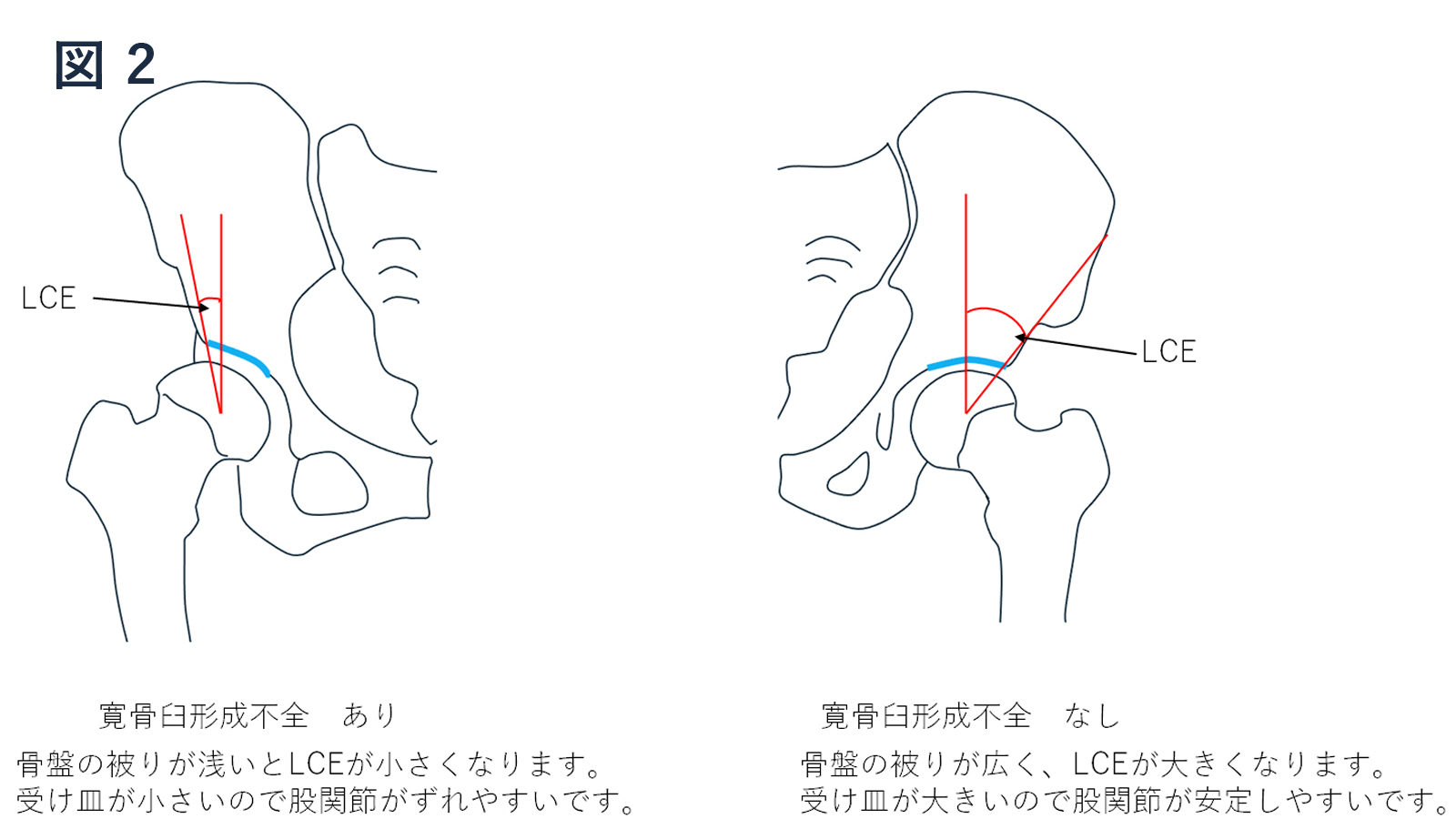 寛骨臼形成不全