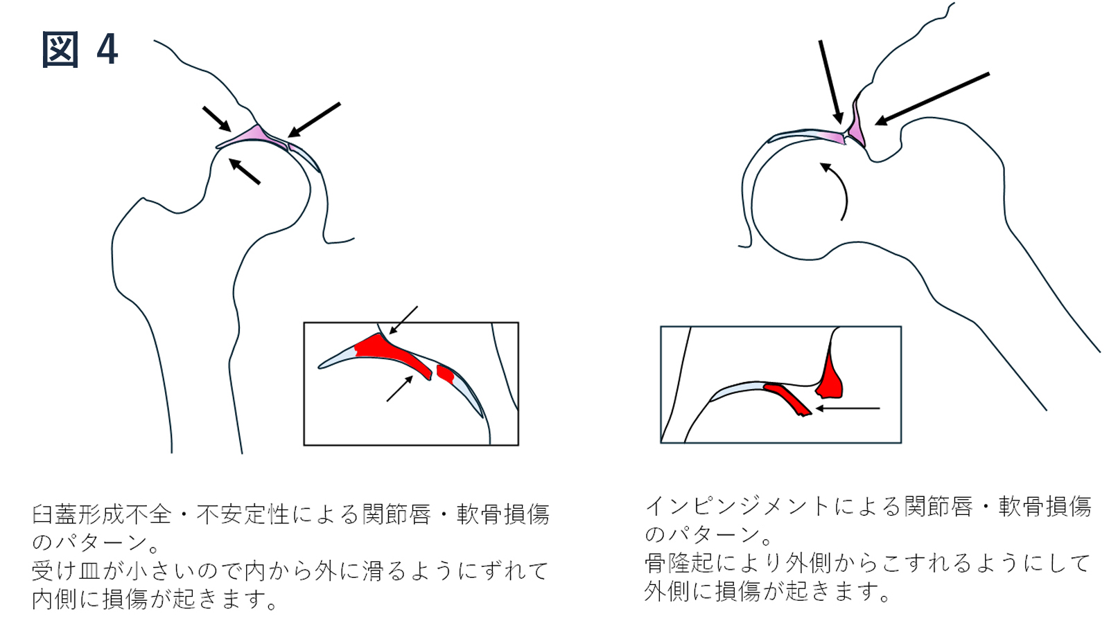 関節唇損傷