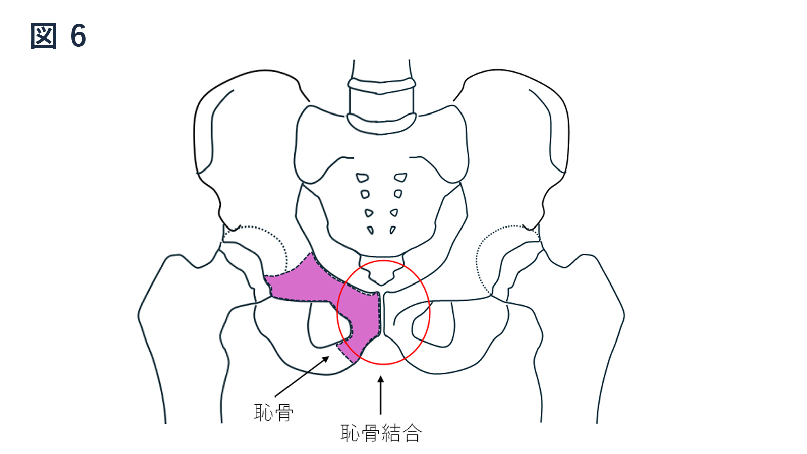 恥骨結合障害