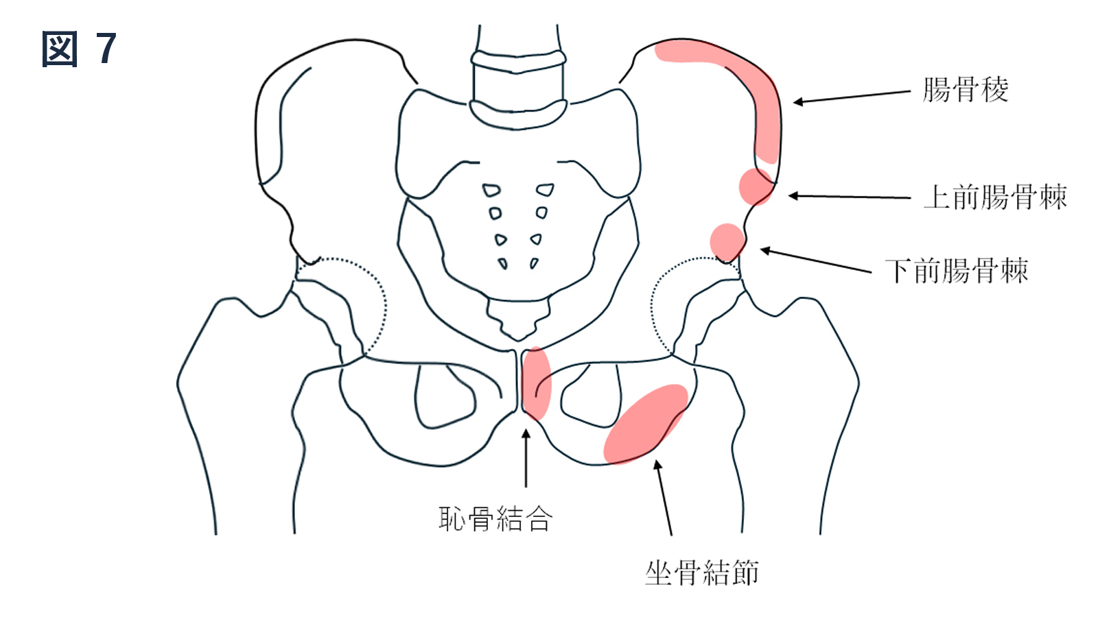 骨盤裂離骨折（一部外傷）