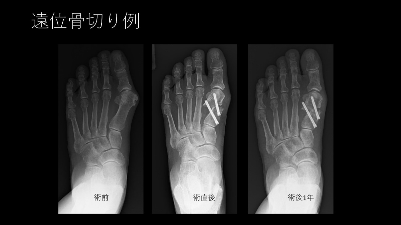 外反母趾