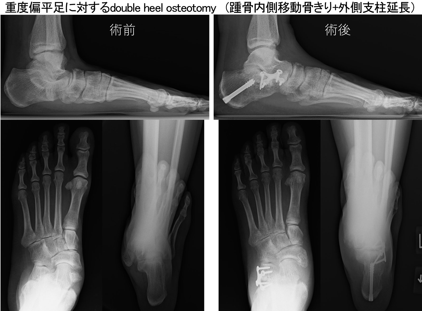 扁平足変形 / 後脛骨筋腱機能不全