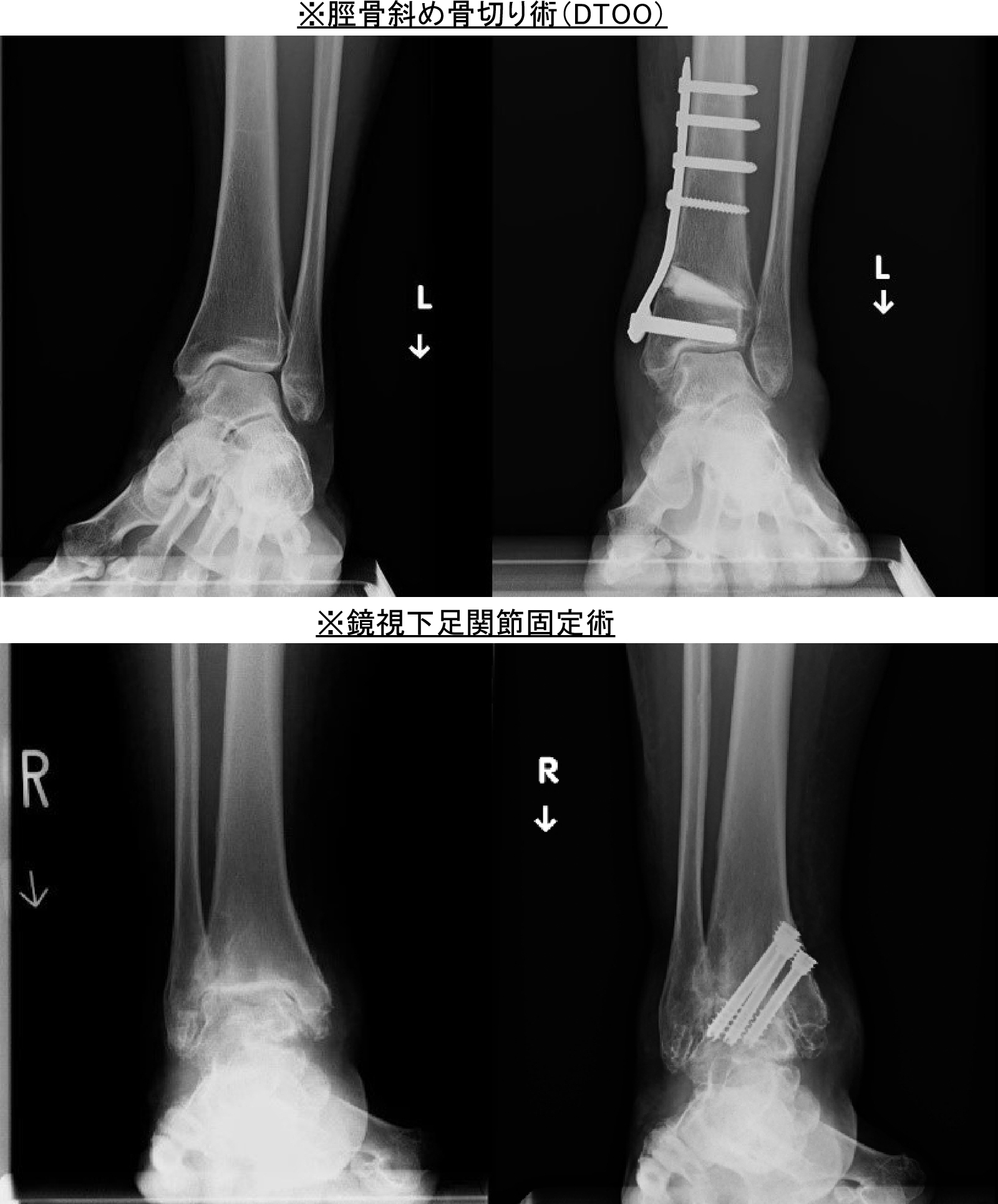 変形性足関節症